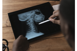 The Neck Fracture With a Name You Don't Forget
